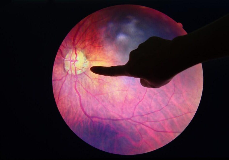Finger pointing at a retinal image.